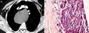 (A) The chest computed tomography with contrast medium shows a large mediastinal mass (12×14cm) without contrast enhancement causing anterior displacement of the large vessels and trachea, and anterolateral displacement of the esophagus. (B) Histopathological examination revealed a pseudocystic wall, which contained hypercellular parathyroid tissue (hematoxylin–eosin staining, original magnification 400×).