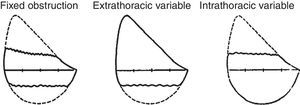 Flow-volume curve patterns suggestive of upper airway obstruction.