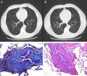 (A and B) An increase in the bronchoalveolar ratio is seen in the high definition CT scan during inspiration and expiration, a radiological sign suggestive of bronchiectasis and diffuse bronchiolectasis. No radiological signs of air trapping are observed. (C) Histological sample obtained from lung biopsy: Masson's trichrome stain; bronchiolar submucosal fibrosis is seen, along with the appearance of small scars. (D) Histological sample obtained from the lung biopsy: hematoxylin–eosin stain: bronchial obliteration can be observed.