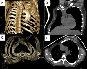 3D reconstruction of the chest wall defect: (A) anteroposterior view with rotation to the left; (B) craniocaudal view. View the defect on chest CT (mediastinal window): (C) coronal slice; (D) axial slice.