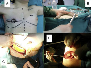 (A) Surgical site markings. (B) Construction and remodeling of the methacrylate prosthesis on the table. (C) Complete reconstruction of the chest wall defect by stabilization with a preformed methyl methacrylate prosthesis. (D) Cover with right latissimus dorsi flap with skin island for subsequent reconstruction of the areola-nipple complex.