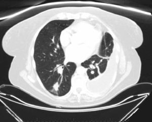 The chest CT scan shows loculated pleural effusion, atelectasia of the lower lobe and lingula, and a 2cm solitary pulmonary nodule in the apical segment of the left lower lobe.