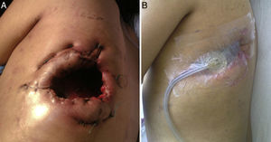 (A) Open thoracic window; 9cm in length were resected from costal arches 8 and 9. (B) Window with VAC™ system.
