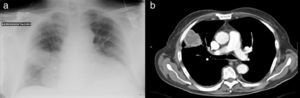 Chest radiograph (a) and chest CT scan (b) right parahilar mass.