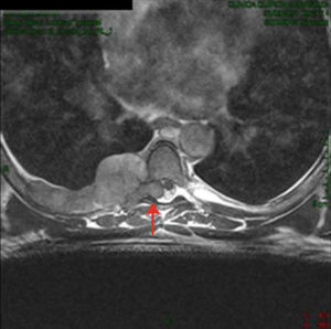 Magnetic resonance imaging: mass with intraspinal involvement (red arrow).