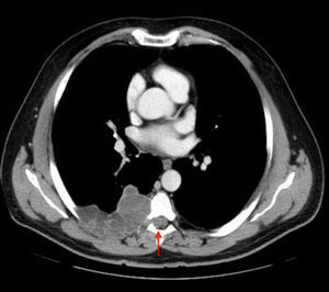 Computed tomography. Note the increased size of the mass in relation to the magnetic resonance.