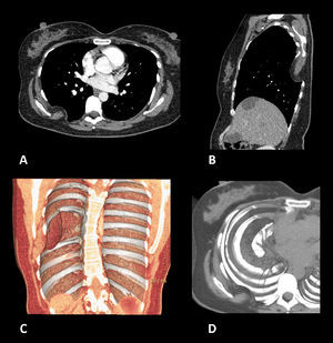 Axial (A) and sagittal (B) CT with contrast, with reconstructions (C,D), in which a convex lens-shaped herniation and incarceration of soft tissue of the right posterior wall of the thorax (subcutaneous fat layer and major rhomboid muscle) can be observed in the pleural cavity via the widened space between the sixth and eighth ribs.