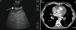 (A) Endobronchial ultrasound image in which a floating thrombus can be observed in a branch of the left lower lobe artery. (B) Chest angio-CT scan; the arrow points to the probable partial filling defect detected by EBUS.