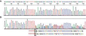 Sequence corresponding to exon 5 SERPINA1. (A) Normal sequence. (B) Sequence corresponding to the patient, which shows insertion of a thymine (T) instead of an adenine (A) at codon 376 in exon 5 of heterozygosity for the PI-Mattawa allele. The SERPINA1 gene coding sequence (exons 2–5) was analyzed using previously described primers for exons 3–5 and 5′ACGTGGTGTCAATCCCTGATCACTG3′ Ex2F primers and ex2R 5′TATGGGAACAGCTGG3′ for exon 2, with reference to the comparative SERPINA1_Transcript_ENST00000440909.
