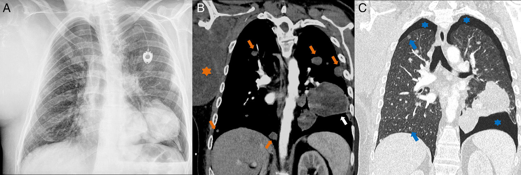 Chemotherapy-Induced Secondary Pneumothorax | Archivos de Bronconeumología