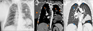 Radiograph (A) and computed tomography (B, C) of the chest in which the sarcoma-axillary level right humerus (orange star) mass in the left lung (white arrow), several solid nodules (orange arrows) are visualized and cavitation (blue arrows) and mild bilateral pneumothorax (blue stars).