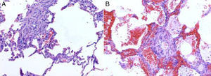 Pulmonary parenchyma with: (A) Passive capillary congestion and foci of hematic extravasation. (B) Medium caliber vessel with thickened wall due to fibrous proliferation of the tunica media.