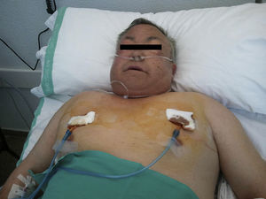 Severe subcutaneous emphysema. Fenestrated catheters placed according to the technique described by Beck, connected to continuous aspiration.