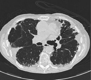 Chest CT scan revealed bilateral irregular pleuroparenchymal thickening, principally in the upper and middle areas, associated with fibrotic signs.