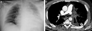 (a) Chest X-ray four days after left lower lobectomy. Alveolar infiltrate can be seen in the remaining lung. (b) Low uptake can be seen on the axial slice of the CT in the left pulmonary artery suggestive of thrombus and changes in lung parenchyma related with interstitial edema.