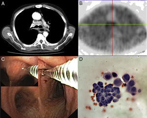 A 67-year-old man presented a mass within lower left lobe with mediastinal involvement on CT scan (part A). MIBI-SPECT showed an increased MIBI uptake to the anterior carina lymph node (part B). We performed a TBNA (part C) shown to be an adenocarcinoma (part D; haematoxylin and eosin; 200× magnification). TBNA, trans-bronchial needle aspiration; MIBI-SPECT, methoxy-isobutyl-isonitrile single photon emission computed tomography.