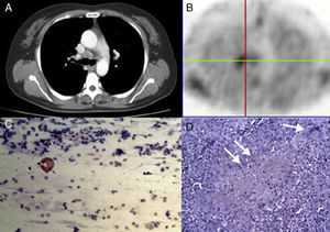 A 57-year-old woman presented with mediastinal involvement of anterior carina on CT scan (part A). The adenopathy was MIBI-avid (part B). TBNA findings showed normal lymphoid tissue suggestive of benign disease (part C; haematoxylin and eosin; 200× magnification). Specimen obtained by mediastinoscopy diagnosed to be a tuberculosis. Langhan's giant cells (white arrow) and inflammatory granulation tissue (double white arrow) were clearly evident (part D; haematoxylin and eosin; 50× magnification). CT, chest tomography; MIBI-SPECT, methoxy-isobutyl-isonitrile; TBNA, transbronchial needle aspiration.
