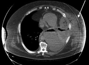 Computed tomography: left pleural effusion communicating with collection in the left anterolateral chest wall.