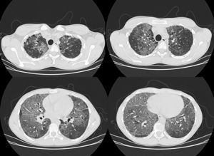 Chest HRCT (axial slices) showing extensive, predominantly basal involvement of the lung parenchyma with the so-called crazy-paving pattern, associated with small areas of subpleural honeycombing in the upper lobes.