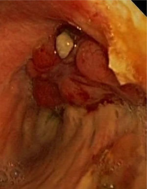 Endoscopic image showing a polylobulated mass with areas of necrosis in the region of the right upper lobectomy stump.