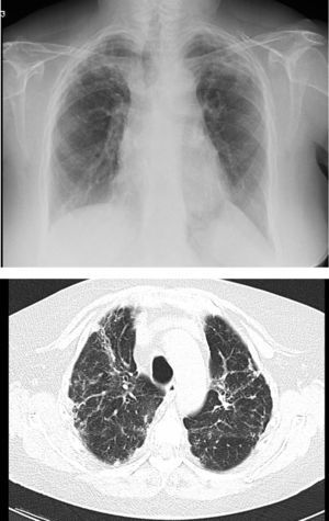 Pulmonary fibrosis changes in upper lobes of a patient diagnosed with restrictive allograft syndrome (chest X-ray and chest CT).