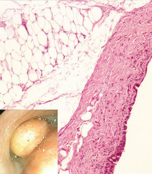 Bronchoscopy image of a shiny, yellowish polypoid lesion that was determined on histology to be a lipoma.
