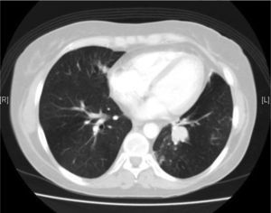 Chest computed axial tomography slice showing an occupation of the segmental and some subsegmental bronchi by soft tissue in the left lung base, probably related to endobronchial tumor disease.