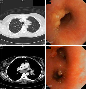 Bronchoscopy and CT images before treatment.