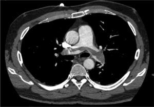 Image obtained by chest angio-CT scan, showing a partially recanalized thrombus straddling the pulmonary arteries, producing 25% obstruction.