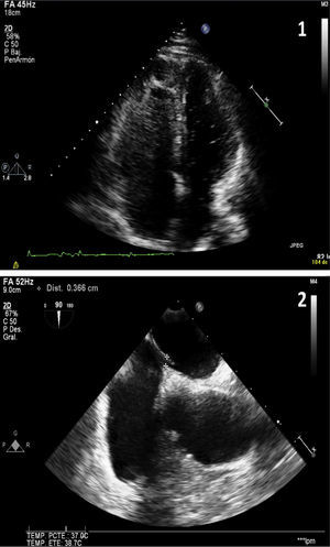 Image 1 (apical view of the four chambers obtained by transthoracic ultrasound): baseline image after injection of contrast material (agitated saline). Higher echogenicity is seen in the right ventricle and right atrium (more grayish color due to microbubbles) and, without the need of Valsalva maneuver, passive passage of microbubbles to the left heart occurs (small hyperechoic spheres). Image 2 (cross-sectional bicaval plane on transesophageal ultrasound): fossa ovalis membrane detachment of up to 3mm.