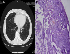 (A) High-resolution computed tomography showing interstitial involvement, characterized by mainly peripheral interlobular septal thickening associated with areas of ground glass opacities. (B) Lung parenchyma with an area of patchy lymphocytic infiltration, alternating with an area of lung parenchyma with no significant histological changes.