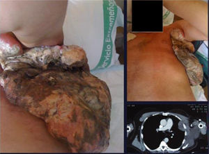 Intra and extra-thoracic MSS localization.