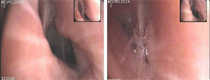 Bronchoscopic image of the left lower lobe during inspiration (left) and expiration (right).