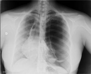 Standard posteroanterior chest X-ray. Right mediastinal shift including heart, loss of bronchovascular markings in the left lung field, suggestive of a large bulla and left apical pneumothorax. Images of cysts with air-fluid level left basal region.