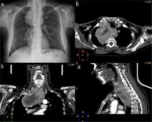 (a) Preoperative chest X-ray. (b) Axial computed tomography (CT) showing a large intrathoracic goiter (IG) in the mediastinum. (c) Coronal CT showing a heterogeneous posterior thyroid mass. (d) Sagittal CT showing IG behind the trachea and the aortic arch.