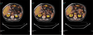 Axial images corresponding to the fusion of PET and CT images for each site. Radiotracer uptake in the right and left crural diaphragm (or “crura”) in a COPD patient is clearly observed (white arrows). Other structures, such as kidneys and liver, also show uptake.