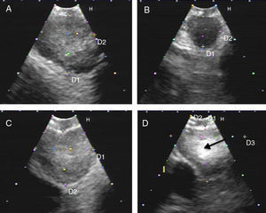 Series of EBUS images of the mediastinal lymph node showing the different criteria: (A) heterogeneous echogenicity with a distinct margin in a reactive lymph node. (B) Homogeneous echogenicity with an indistinct margin in a reactive lymph node. (C) Heterogeneous echogenicity with a distinct margin in adenocarcinoma. (D) Hyperechogenic density in the interior of a lymph node (arrow) in small cell carcinoma. The lymph node images (A–D) show the absence of central hilar structure.