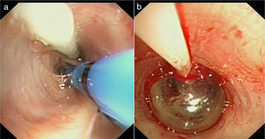 (a) Endoscopic image of the occlusion balloon placed parallel to the cryoprobe in the entrance to the right lower lobe (RLL) segmental bronchus. (b) Endoscopic image of the inflated occlusion balloon after performing the transbronchial lung biopsy.