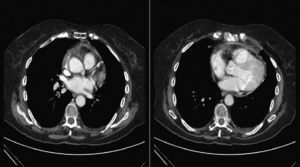 Chest computed tomography showing small left pleural effusion and minimal pericardial effusion.