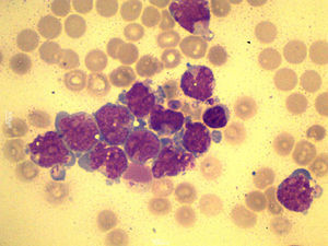 Microscopic examination of pleural fluid, showing cells with lax and immature chromatin, raised nuclear–cytoplasmic ratio and visible nucleoli, compatible with myeloblasts (May-Grünwald/Giemsa staining, 1000×).
