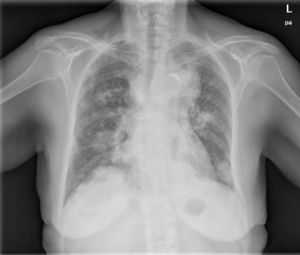Posteroanterior chest X-ray showing left upper lobe mass and multiple bilateral nodules suggestive of metastasis.