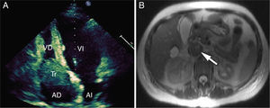(A) Transthoracic four-chamber ultrasound, apical view, showing large thrombus in the right atrium shifting toward the right ventricle during diastole. AD, right atrium; AI, left atrium; Tr, thrombus; VD, right ventricle; VI, left ventricle. (B) Abdominal magnetic resonance image of inferior vena cava thrombosis.