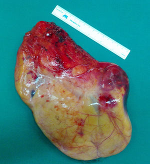 Gross view of the thymolipoma. Encapsulated fatty mass with regular, translucid, vascularized surface. Measurements: 21×17×5cm. Weight: 903g.
