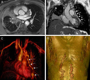 (A) Axial T1-weighted MRI showing a mass in the right pulmonary hilum. The main bronchus is surrounded by the mass (not shown), causing atelectasis of the middle lobe. (B) Coronal MRI showing dilated veins (pericardial varices) along the lateral surface of the pericardium (arrows). Atelectasis of the middle lobe can also been seen. (C) Reformatted 3D MRI showing dilated pericardial veins (pericardial varices: arrows). (D) Reformatted 3D MRI showing collateral circulation in chest and abdominal walls.