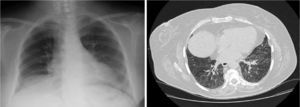 Posteroanterior chest X-ray and high resolution computed tomography (HRCT) showing improvement of infiltrates with persistent ground-glass opacities in the HRCT slice.