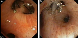 Endobronchial valves located in the segmentary bronchi. (A) IBV valve in right B1 and B2. (B) Z-EBV valve in right B1.