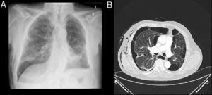 Patient with right pneumothorax and lung emphysema (patient no. 5). (A) Chest X-ray after chest tube placement. (B) Detail of chest X-ray.