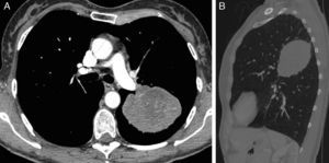 Chest computed tomography images [axial (A) and sagittal (B)] showing a heterogeneous elliptic tumor with contrast uptake in the oblique fissure of the left hemothorax.