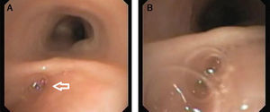 (A) A tracheal pouch in the posterior tracheal wall was observed using flexible bronchoscopy (white arrow), near the carina. (B) Air bubbling was then seen during bag valve mask ventilation administered by the anesthesiologist, suggesting a communication between the esophagus and the pouch.