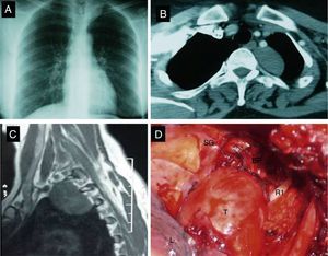 (A) Chest X-ray showing left paratracheal opacity. (B) Chest computed tomography showing an encapsulated mass in the left posterosuperior mediastinum at the T2–T3 level. (C) Chest magnetic resonance image: well-defined tumor in the left paravertebral region with no compression of the spinal cord and no direct vertebral invasion. (D) Direct image of ganglioneuroma during surgery. R1: first rib; SG: stellate ganglion; L: lung; BP: brachial plexus; T: tumor.
